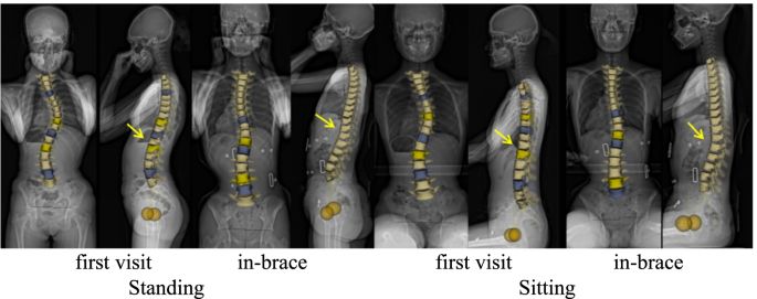 Predicting brace adherence could change the game in scoliosis treatment