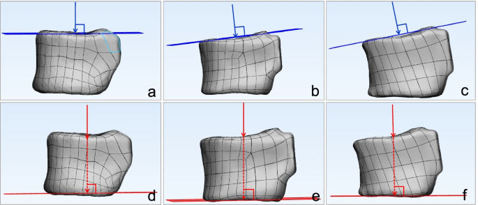 Medical Science Monitor  Biomechanical Behavior of All-on-4 and M-4  Configurations in an Atrophic Maxilla: A 3D Finite Element Method - Article  abstract #929908