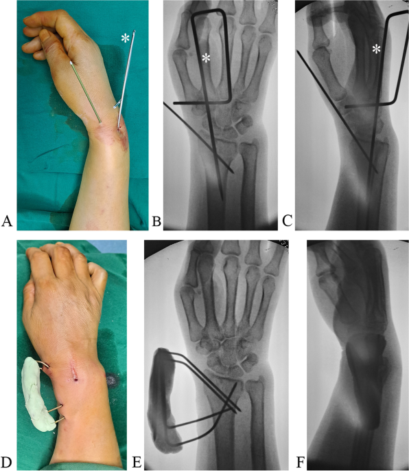 Treatment of distal radius fractures using a cemented K-wire frame | BMC  Musculoskeletal Disorders | Full Text