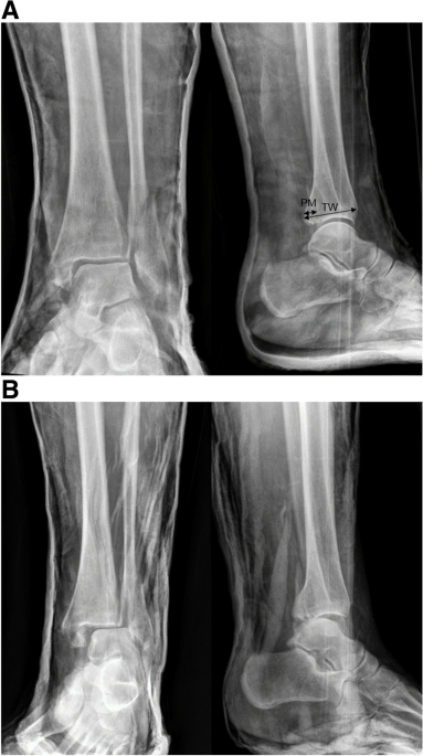 Temporizing cast immobilization is a safe alternative to external fixation  in ankle fracture-dislocation while posterior malleolar fragment size  predicts loss of reduction: a case control study, BMC Musculoskeletal  Disorders