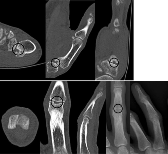 Revista Brasileira de Ortopedia - Treatment of Distal Radio Vicious  Consolidation: Corrective Osteotomy Through 3D Printing  Prototyping<sup>*</sup>