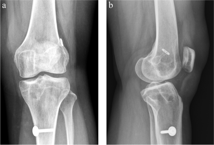 TIBIA BY HYBRID FIXATION