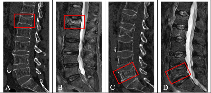 Differentiation of acute and chronic vertebral compression