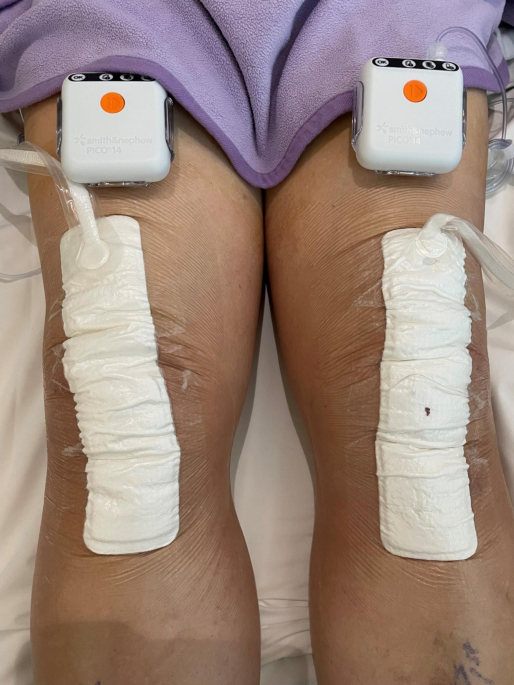 Single use Negative Pressure Wound Therapy (NPWT) system in the management  of knee arthroplasty | BMC Musculoskeletal Disorders | Springer Nature Link