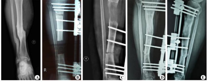 Double-level, proximal-to-distal bone transport using wire fixation. A