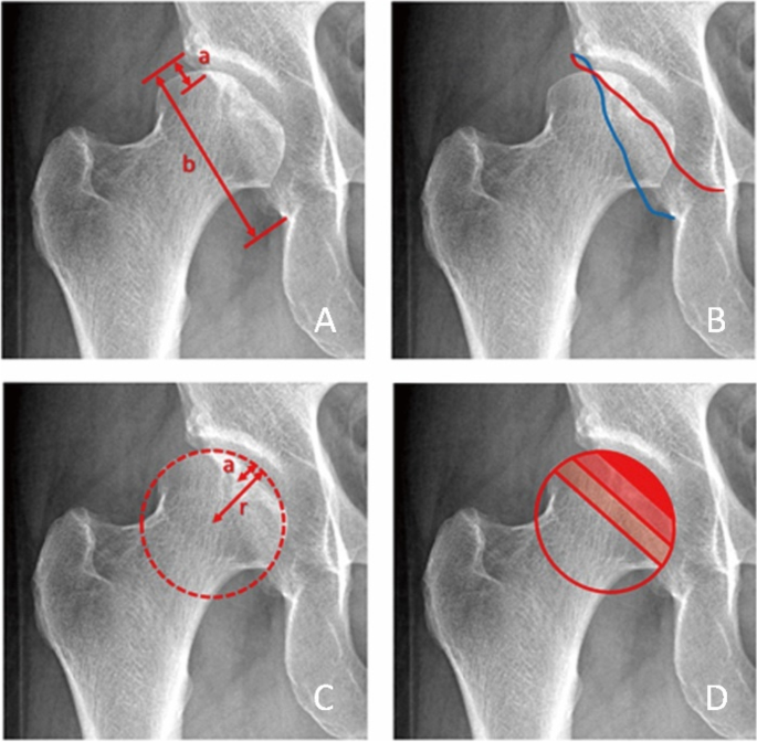 Anterior, posterior and lateral views of a participant with D-Cup