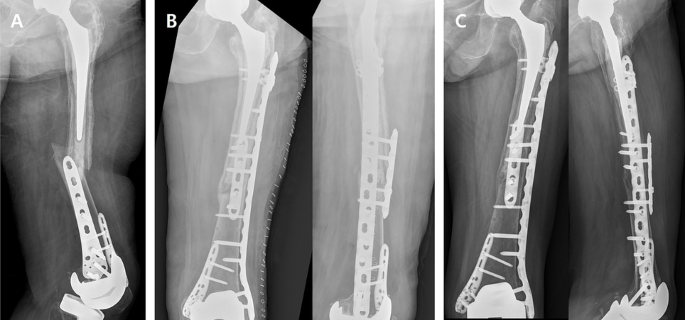 Plate osteosynthesis combined with bone cement provides the