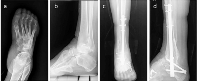 Arthroscopic Ankle and Subtalar Arthrodesis – Indications and Surgical  Technique | IntechOpen