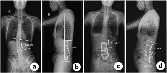 PDF) A review of minimally invasive techniques for correction of adult  spine deformity