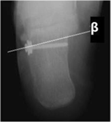 Calcaneus (heel Bone) X-ray by Photostock-israel