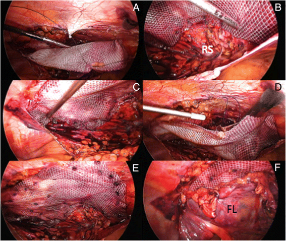 Meshes applied to the abdominal wall defect: (A) Surgical glue and (B)