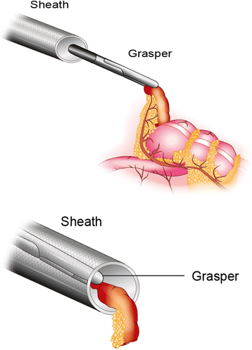 Cureus | Laparoscopic Appendectomy Using the Surgical-Glove Port Through an  Umbilical Incision: A Single-Center Retrospective Study | Article
