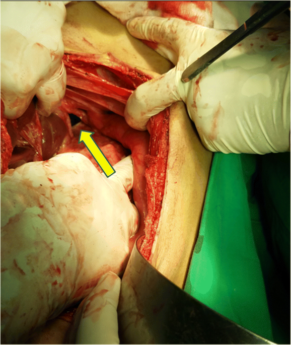 Inguinal Hernia Surgery - Treatment, Diagnosis & Repair - MH Surgery Clinic