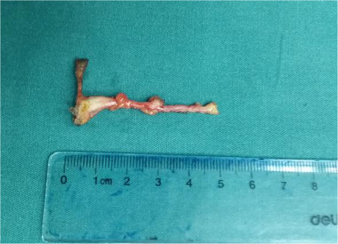 Removal of a broken acupuncture needle in retroperitoneum by laparoscopy: a  case report | BMC Surgery | Full Text