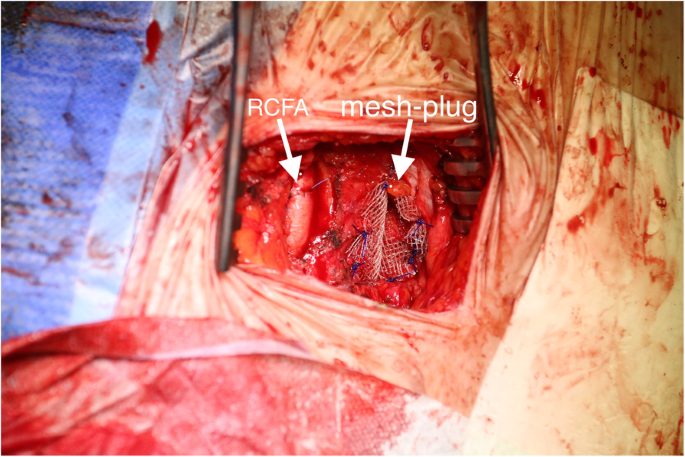 Femoral hernia in the era of TAVI – a potential obstacle for transfemoral  approach: a case report and literature review, BMC Surgery