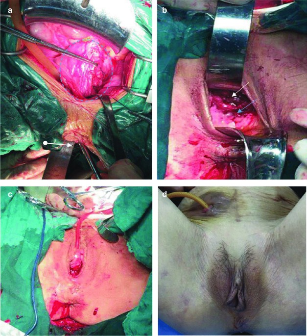 Management of pelvic organ prolapse of ruptured and extruded