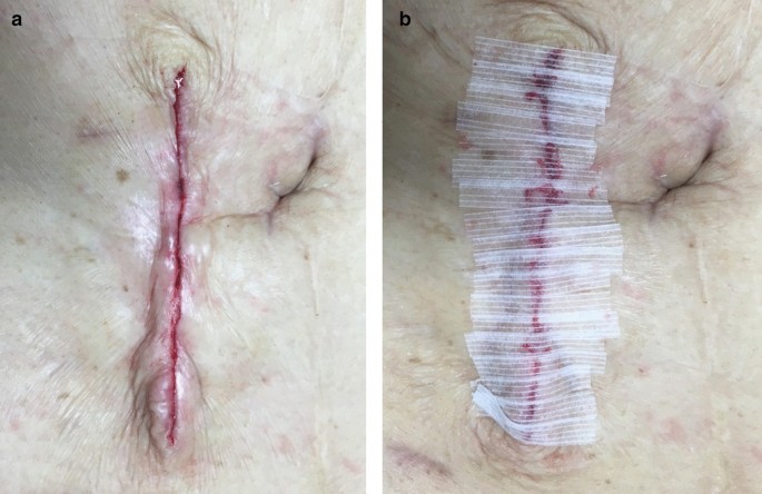 The technique for less infectious and earlier healing of stoma closure  wound: negative pressure wound therapy with instillation and dwelling  followed by primary closure, BMC Surgery