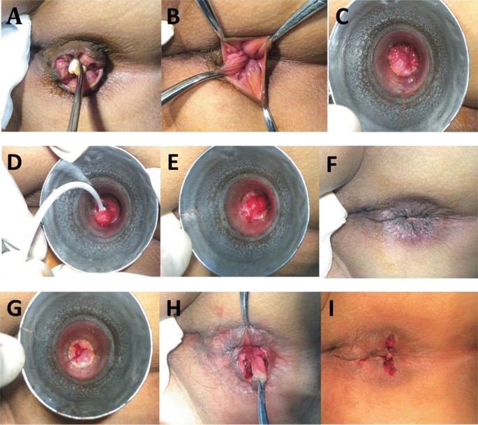 bpc 157 hemorrhoids Efficacy of Ruiyun procedure for hemorrhoids combined simplified  Milligan–Morgan hemorrhoidectomy with dentate line-sparing in treating  grade III/IV hemorrhoids: a retrospective study | BMC Surgery