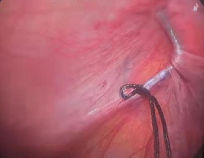 Umbilical two-port laparoscopic percutaneous extraperitoneal
