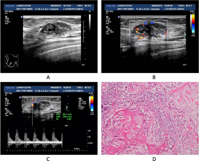 Sonographic and pathological features of metaplastic squamous cell