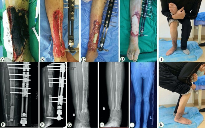 Posttraumatic Reconstruction of the Ankle Using the Ilizarov