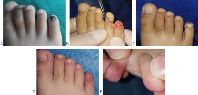 What to Do About Fingernail and Toenail Injuries: James Y. Lee, DO: Family  Practice and Urgent Care