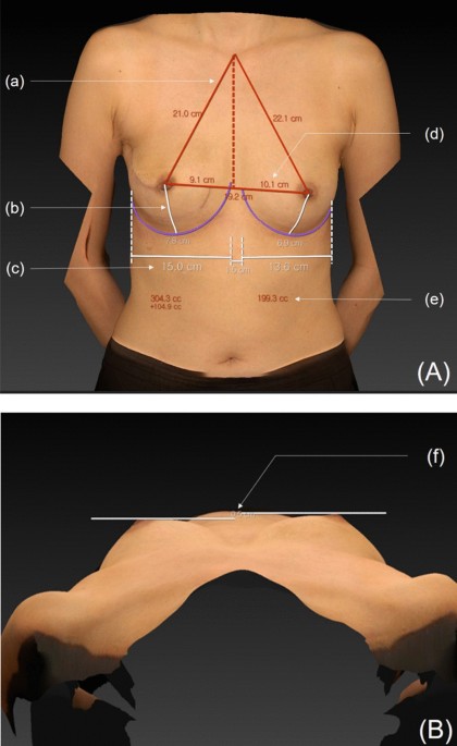 Breast parameters. Sn, sternal notch; iMF, inframammary fold; inD