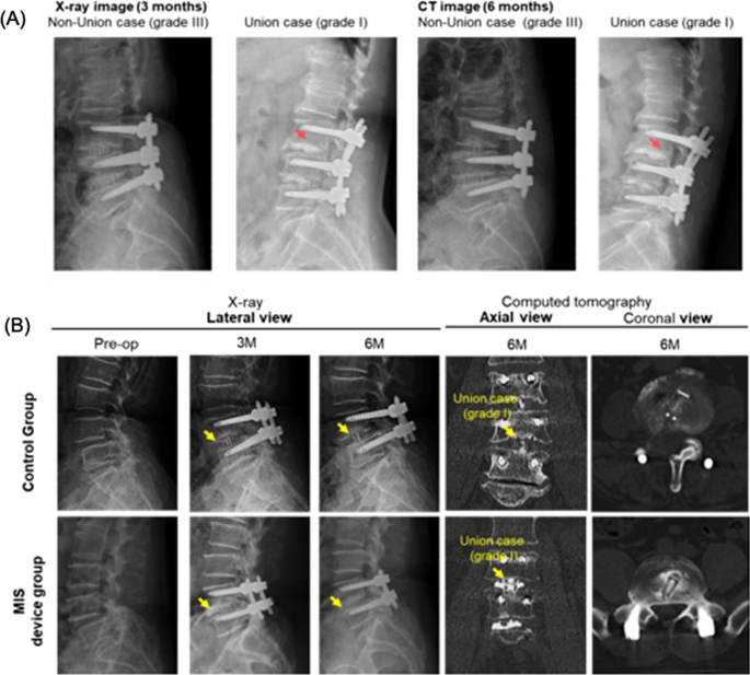 Insufflated Laparoscopic Model - PulseMDM