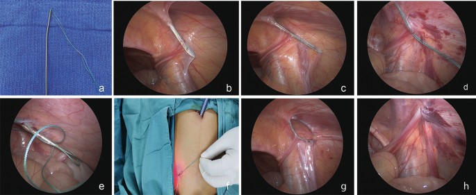 Comparison of laparoscope-assisted single-needle laparoscopic