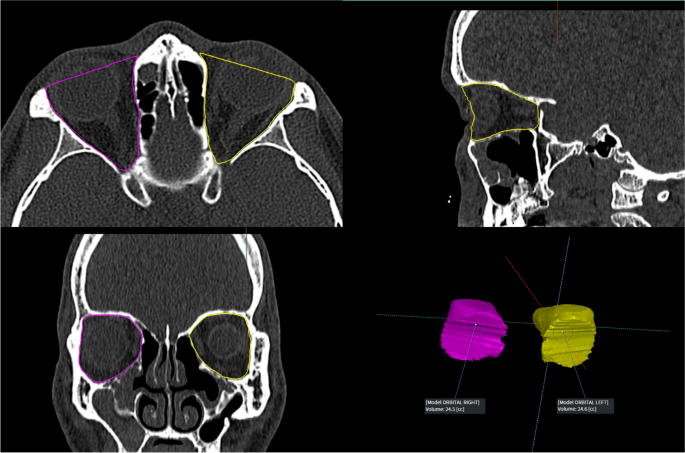 Summary of Results Using the Three-Dimensional Computed Tomographic
