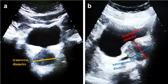 Comparison of prostate volume measured by transabdominal ultrasound and MRI  with the radical prostatectomy specimen volume: a retrospective  observational study | BMC Urology | Full Text