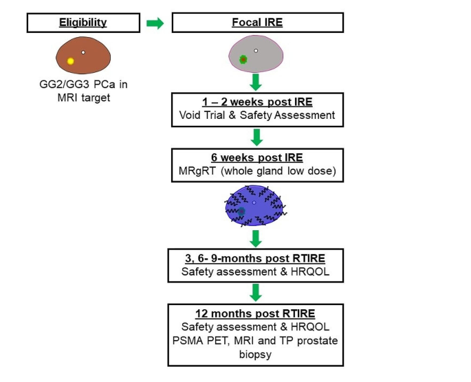 Radiation therapy and IRreversible electroporation for intermediate risk prostate cancer (RTIRE)