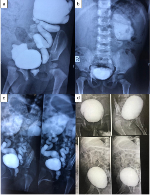 Simultaneous primary posterior urethral valves ablation and bladder neck incision may decrease kidney and bladder failure in long-term follow-up in patients with bladder neck hypertrophy and poor bladder function at presentation: report of 301 cases
