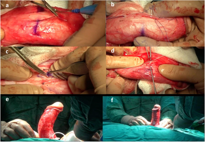 bpc 157 heal nerve damage penile shaft Does BPC-157 Cause Erectile Dysfunction? Evidence and Safe Treatments Bolt Pharmacy BPC 157 Therapy and the