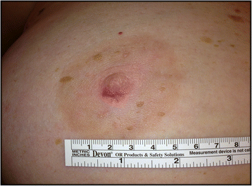 Nipple adenoma in a female patient presenting with persistent erythema of  the right nipple skin: case report, review of the literature, clinical  implications, and relevancy to health care providers who evaluate and