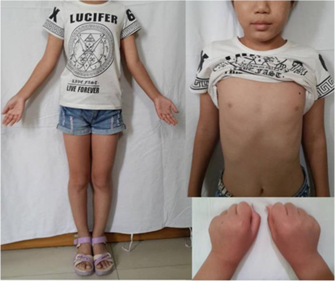 A patient with 46,XY/47,XYY karyotype and female phenotype: a case report |  BMC Endocrine Disorders | Full Text