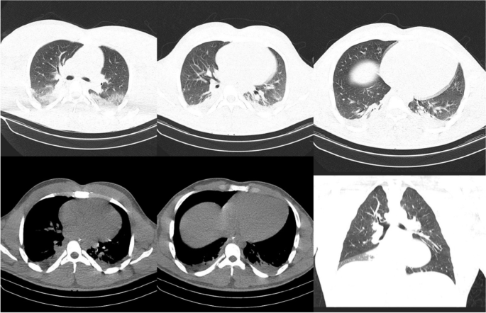ipamorelin overdose Fatal overdose from injection of human growth hormone; a case report and  review of the literature | BMC Endocrine Disorders