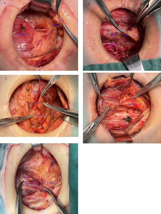 Clinical significance of retrograde inferior parathyroid protection technique based on thymus preservation in thyroid surgery