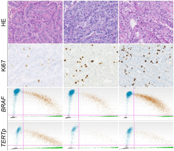 Interplay of BRAF and TERT promoter mutations and Ki67 proliferation index in papillary thyroid carcinoma in Central Asians