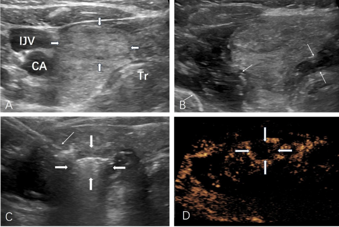 Comparison of thyroid-specific quality of life after thermal ablation vs. thyroid lobectomy for benign thyroid nodules