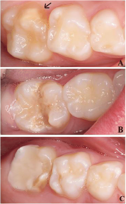 Five-minute Apgar score ≤ 5 and Molar Incisor Hypomineralisation (MIH) – a  case control study | BMC Oral Health | Full Text