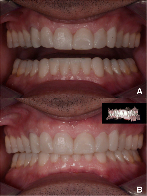 Definitive veneers and crowns prepared digitally using prosthetic