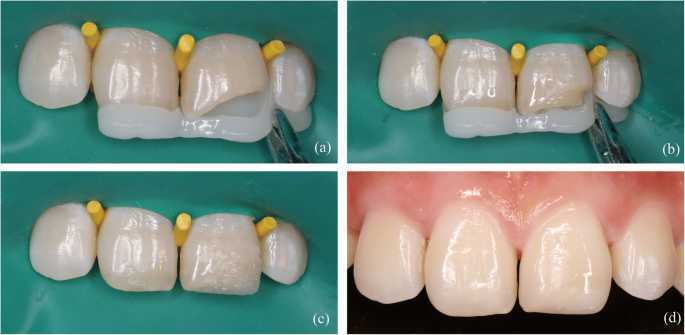 Direct resin composite restoration of maxillary central incisors using a  3D-printed template: two clinical cases | BMC Oral Health | Full Text