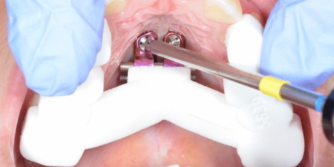 CBCT and CAD-CAM technology to design a minimally invasive maxillary  expander, BMC Oral Health