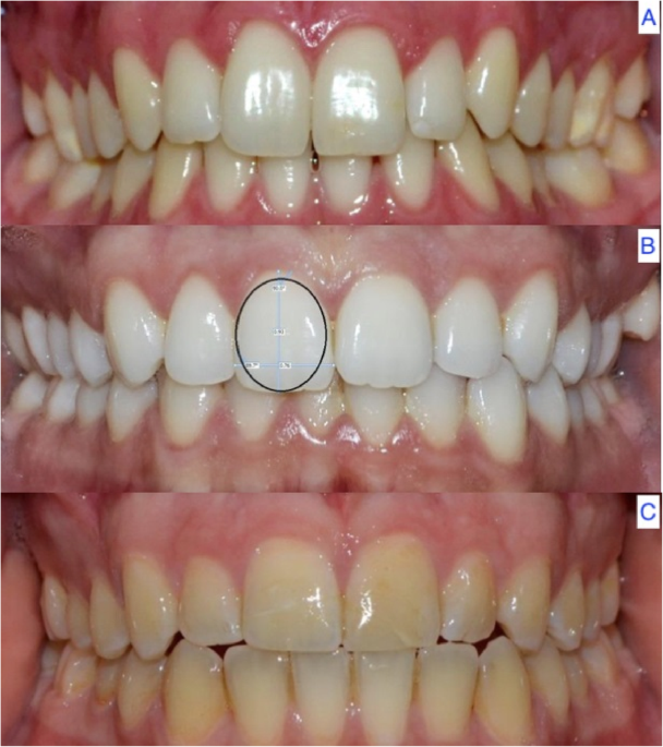 Evaluation of the maxillary midline, curve of the upper lip, smile line and tooth  shape: a prospective study of 140 Caucasian patients | BMC Oral Health |  Full Text