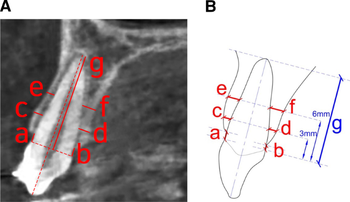 Representative images of a (A) 3-mm and (B) 6-mm apical plug and