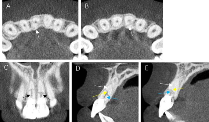 A) Preoperative periapical radiograph of tooth #21. Note the