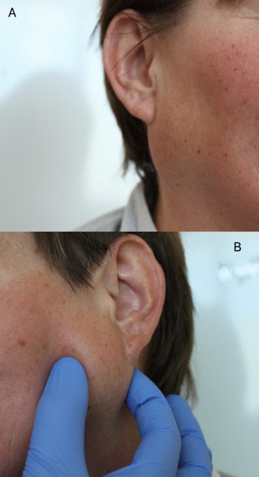 Synchronous bilateral multifocal basal cell adenomas of the parotid gland—a  case report | BMC Oral Health | Full Text