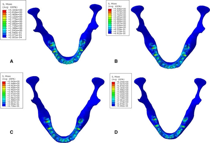 Stability of different fixation methods after reduction malarplasty under  average and maximum masticatory forces: a finite element analysis, BioMedical Engineering OnLine