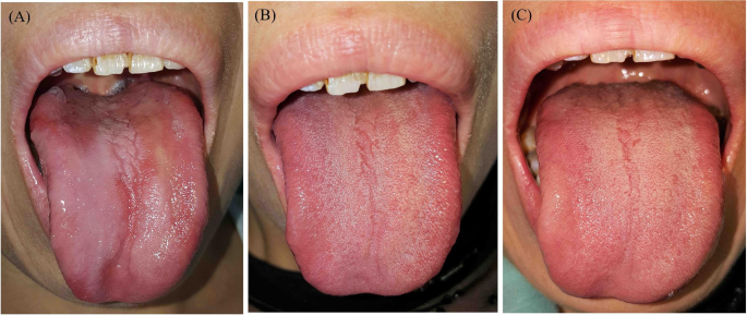 Vitamin B12 deficiency may play an etiological role in atrophic glossitis  and its grading: A clinical case-control study | BMC Oral Health | Full Text